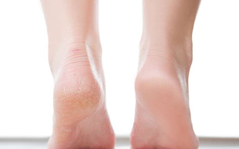 Simple tips to prevent cracked heels!
